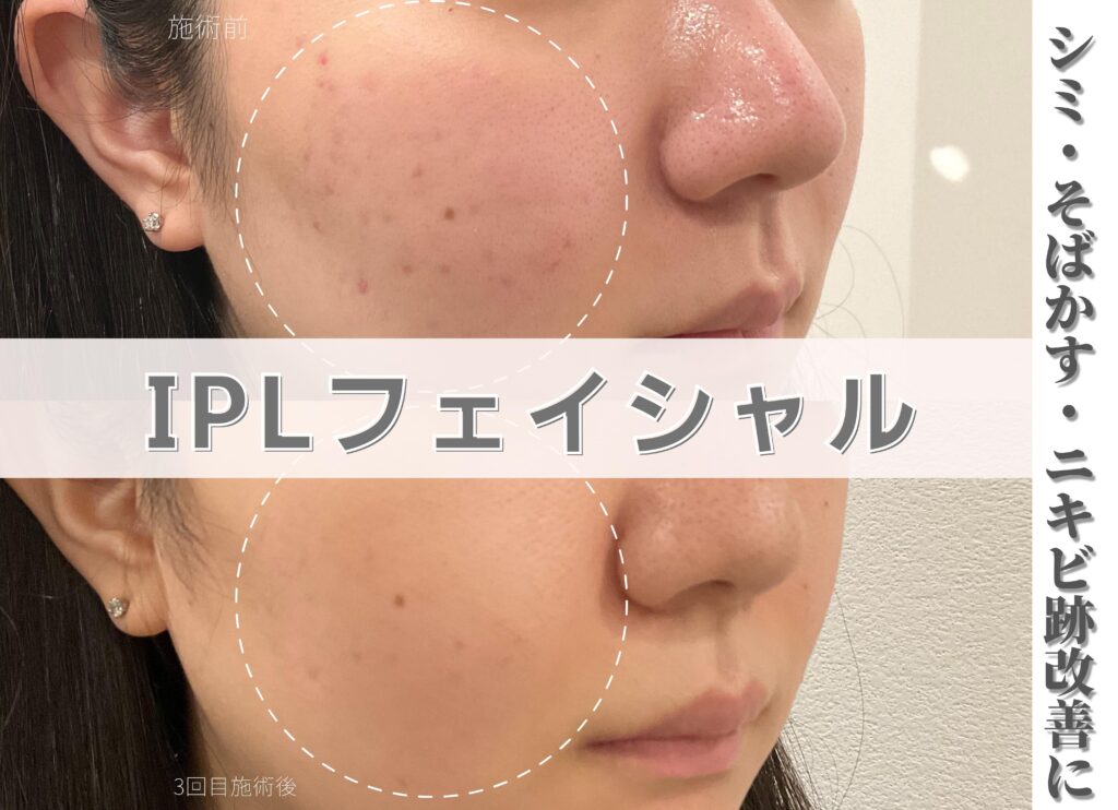 IPL症例