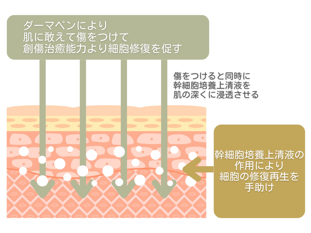 ダーマペンと幹細胞培養上清液の相乗効果